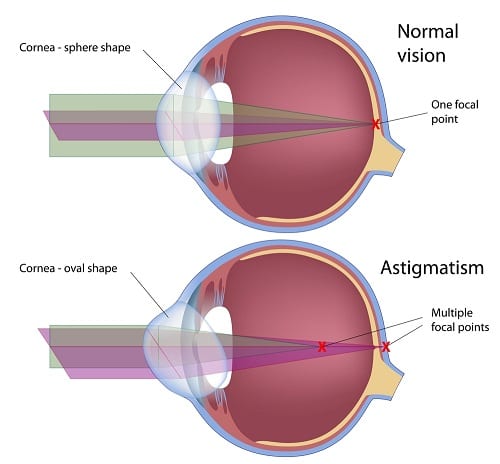 Astigmatism Diagram