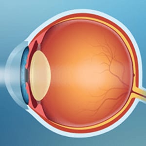 Illustration Showing How Light Enters an Eye With a Cataract