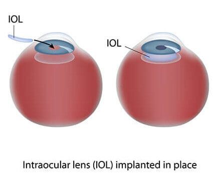 Intraocular lens implantation