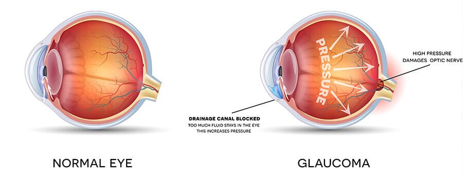 Glaucoma Chart