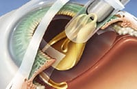 Cataract Surgery Procedure