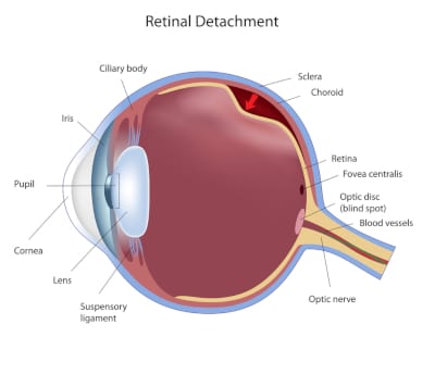 Retinal Detachment Diagram