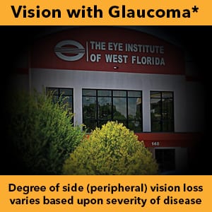 Vision with Glaucoma - Degree of side (peripheral) vision loss varies based upon severity of disease