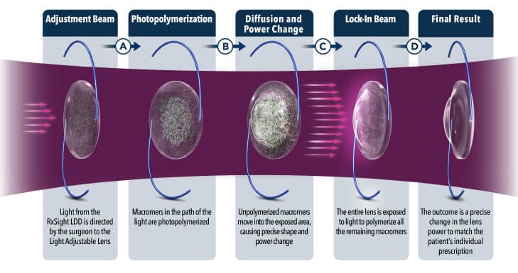 Light Adjustable Lens Example