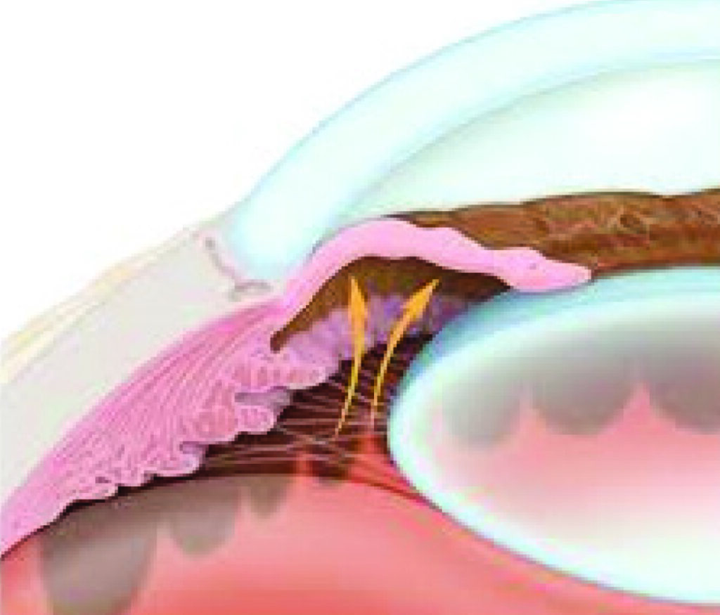 Glaucoma Tampa | Iridoplasty Tampa | Eye Institute