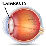 Cataract Surgery Clearwater